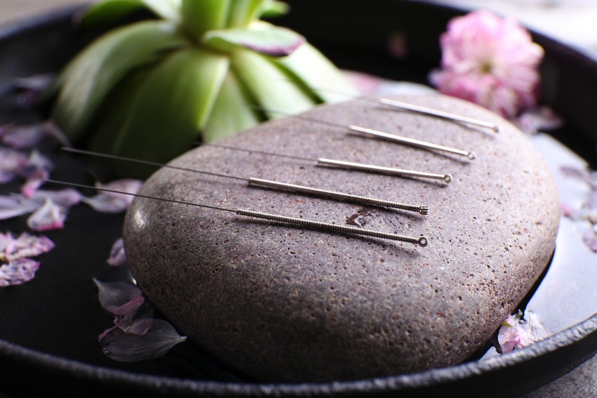5 Ways Acupuncture Can Compliment Your Lifestyle
