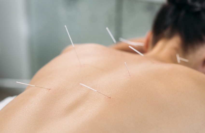 Uses and Benefits of Acupuncture